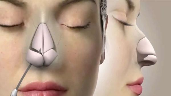 افضل دكاترة تجميل الانف في الرياض