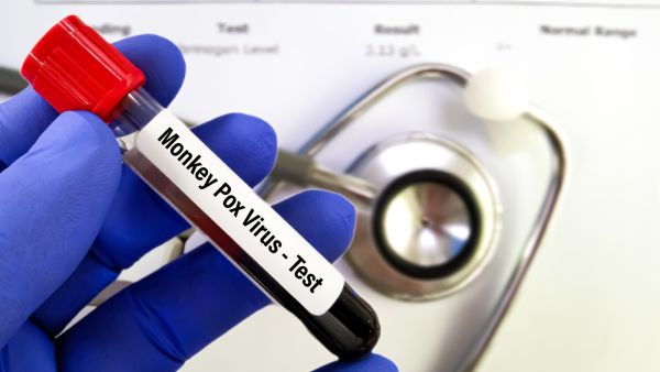 اختبار جدري القرود RT-PCR أصبح متوفراً    