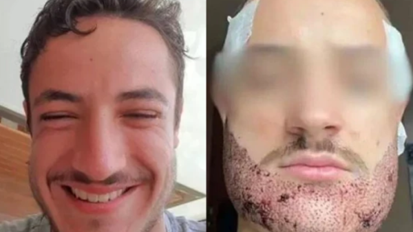 انتحار شاب فرنسي بعد فشل عملية زراعة اللحية