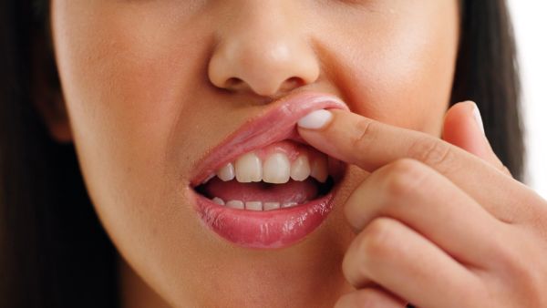 أسباب التهاب اللثة المستمر