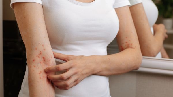 مرض الجرب: الأنواع، الأعراض، المضاعفات، طرق العلاج