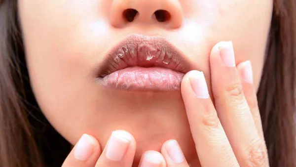 جفاف الفم المستمر، يعد مؤشرا على احتمالات الإصابة بالتهاب المفاصل (shutterstock.com)
