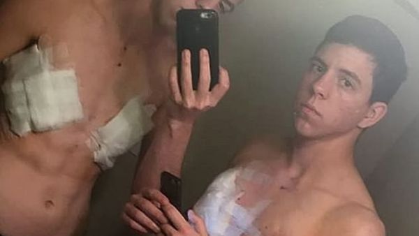 The twins, who have the same DNA, have grown facial hair since they began taking testosterone in April 2017 and underwent chest surgery in August 2018. Jack left, Jace right post surgery in August 2018 (dailymail)
