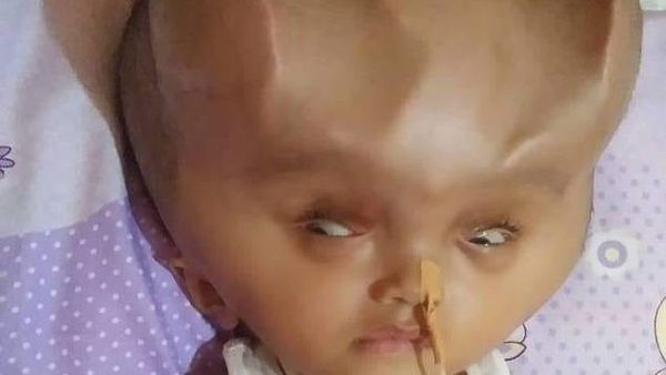 Clyne Solano, 22 months old, has a condition called hydranencephaly which has stopped his brain from developing properly but left him with an enlarged skull containing a lot of fluid (dailymai)