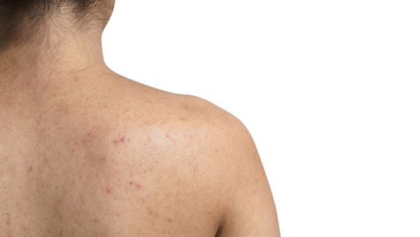 يعطي حب الشباب مظهراً غير لائق للبشرة
