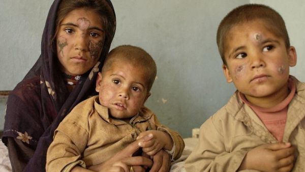 Three Afghan children infected with leishmaniasis sit on a hospital bed at the Maywan Hospital in Kabul. [AFP/Mandel Ngan]
