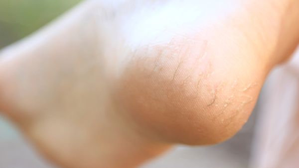 تعاني العديد من النساء من مشكلة تشقق القدمين خاصة في الشناء (shutterstock.com)