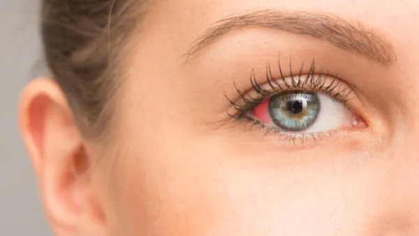 من أسباب ظهور بقع دم في العين ارتفاع مستوى السكر في الدم

