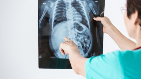 سرطان العظام مرض خبيث يعمل على تدمير خلايا العظم السّليمة
