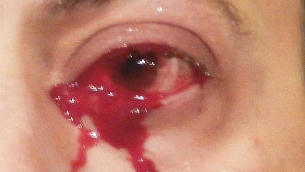 Man who cries blood (Twitter)