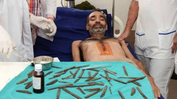 شرطي هندي ابتلع 40 سكينا خلال شهرين