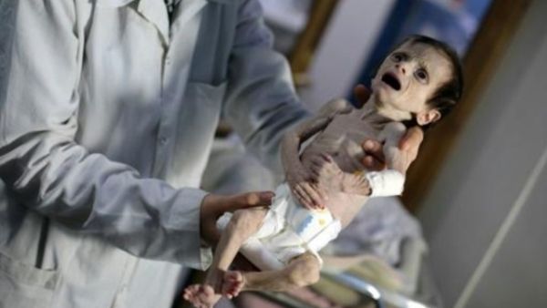 طفلة سورية تعاني سوء التغذية في بلدة حمورية في الغوطة الشرقية المحاصرة
