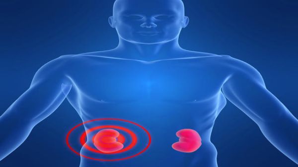 An illustration of kidney inflammation (Shutterstock/Sebastian Kaulitzki)  