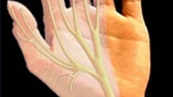الخدران أو التنميل في اليد هو إحساس المريض بخدران أو بوخز كالابر أو عدم الراحة أو حرارة 