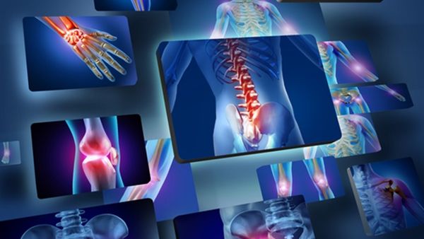 هشاشة العظام لها تأثير مدمر على حياة الكثير من الناس