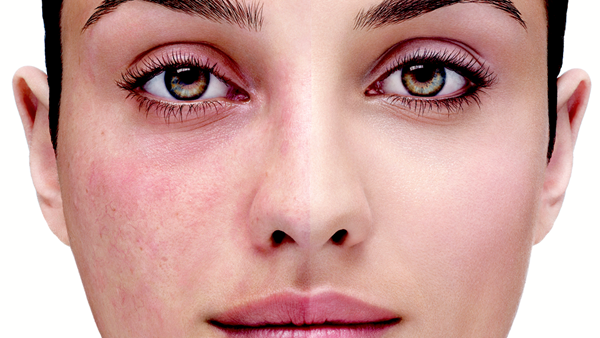 يمكن أن تؤثر الوردية أيضا على المناطق المحيطة بالعنق والظهر والصدر