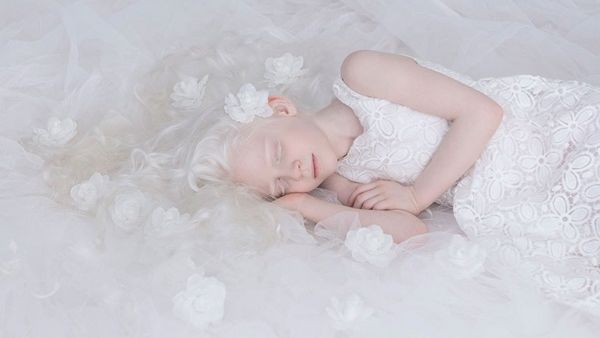 نظرة مختلفة وانسانية للاطفال المصابين باضطراب آلبينو