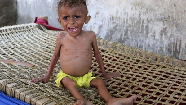 A malnourished Yemeni boy sits on a wooden bench. (AFP)