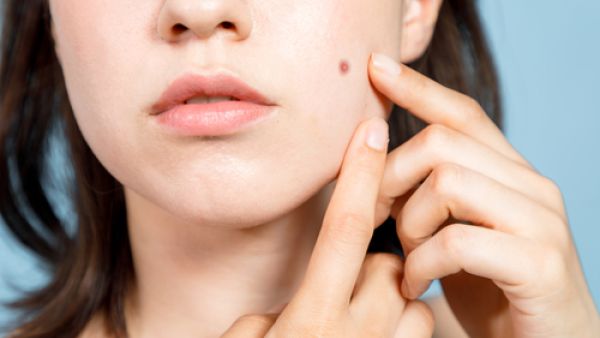 الشامات هي بقع جلديّة غير مؤذية تمتاز بلونها البنّي

