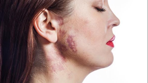 دلكي الوحمه بعصير الليمون المخفف بالماء 3 مرات يومياً