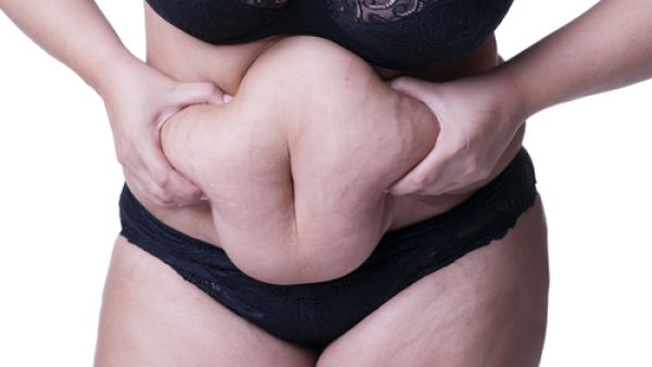 تشققات الجلد المصاحبة للحمل من أكثر الأشياء التي تؤذي نفسية الحامل

