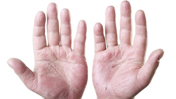 Psoriasis is a chronic, genetic autoimmune disease that causes red, scaly patches on the skin. 