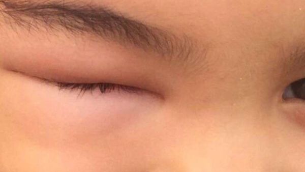 A Saudi child suffering from mosquito bites has his eye swollen shut. (Twitter)