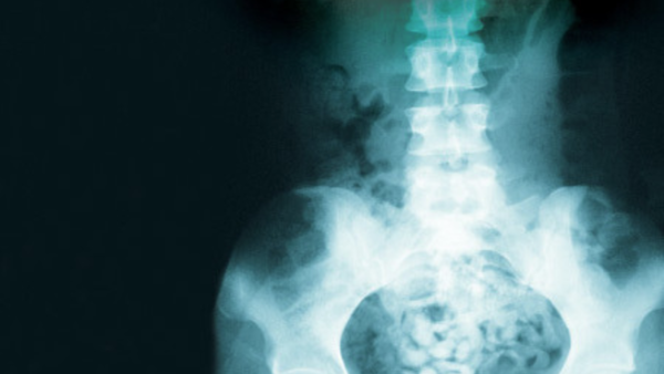 An X-Ray of the man's bowels show the mass of heroin pills. Not a nutritious lunch. (Image courtesy of 7Days)