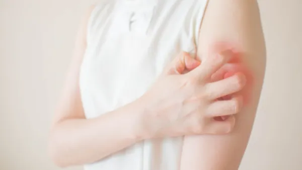 من أسباب الطفح الجلدي التعرّض لمستحضرات التجميل الخاصّة بالأطفال
