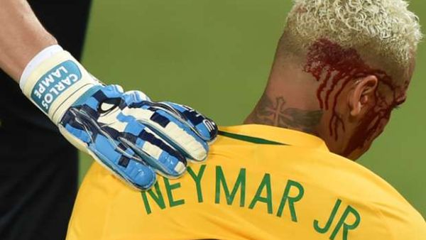 نيمار والدماء تسيل من وجهه