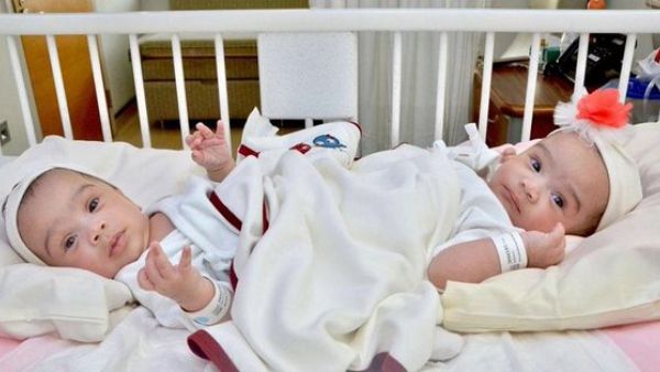 Saudi Siamese twins Sheikha and Shumukh  (Twitter)