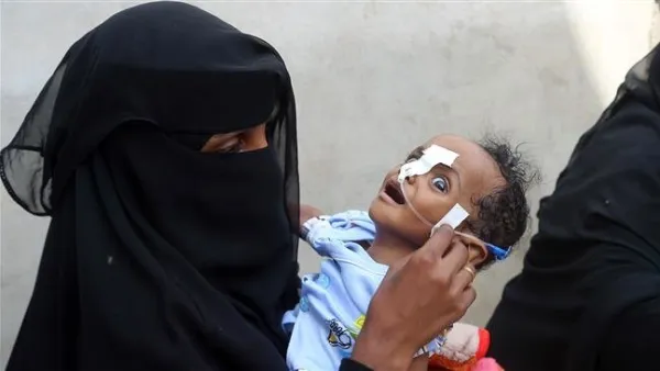 A Yemeni woman carries a malnourished child as she waits during food distribution in the province of al-Hudaydah in western Yemen, May 30, 2018. (AFP)