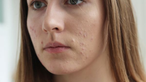 ظهور حب الشباب قبل الدورة بسبب إنخفاض مستوى الهرمونات
