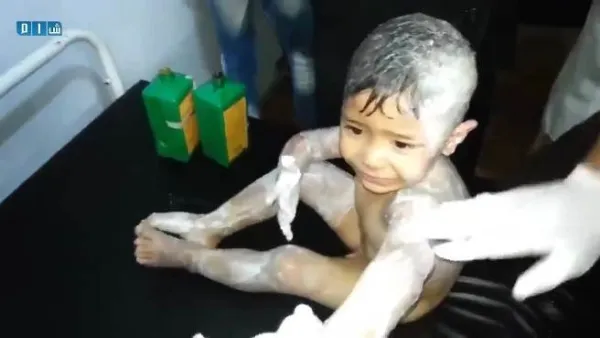 حروق بالغة سببت له رعبا ورعشة شديدة من هول ما حدث له 