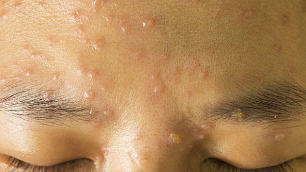 Chicken pox. (Shutterstock)