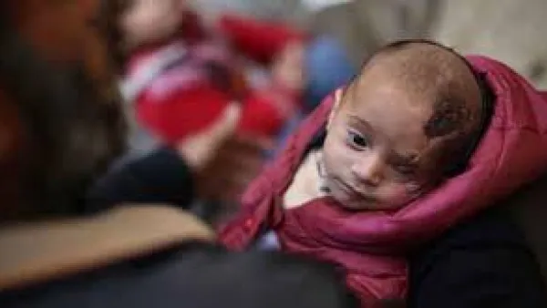 A symbol of resistance to Syria’s Assad regime, “Baby Karim”, who lost one eye to a regime airstrike (AFP/File Photo)

