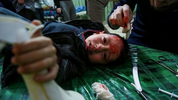 An injured child being treated in a makeshift hospital in Eastern Ghouta (AFP/HAMZA AL-AJWEH)