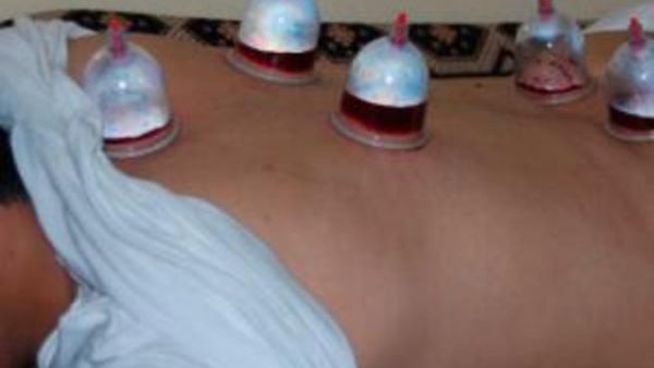 Cupping therapy is growing in popularity throughout Yemen's capital