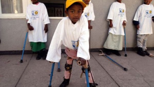 A child suffering from polio.