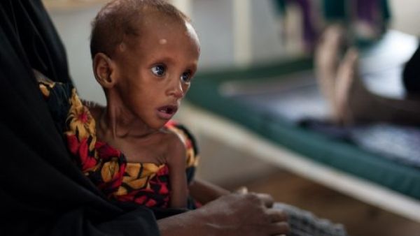 طفل صومالي يعاني من سوء تغذية حاد ينتظر في عيادة اطباء بلا حدود في دداب في كينيا،
