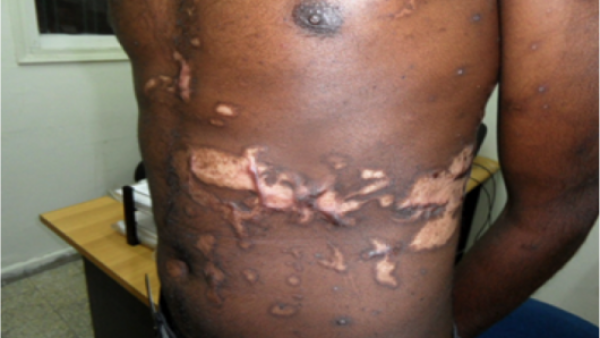 This Eritrean man was badly abused while being held in Sinai.