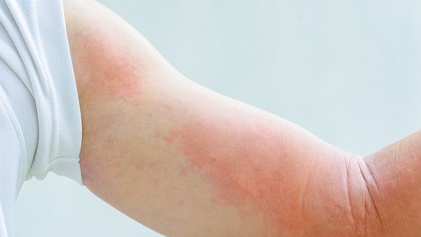 Symptoms of an Allergic Reaction to Insect Bites Can Include Rash