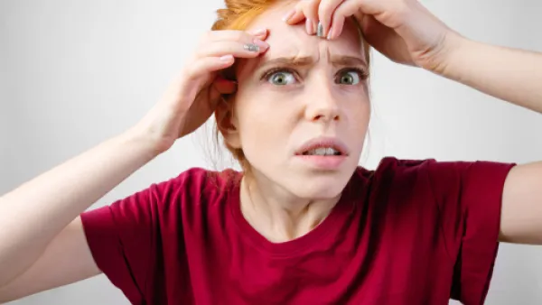 تعد آثار حبوب الوجه من أكثر المشاكل المنتشرة بين الناس (shutterstock.com)