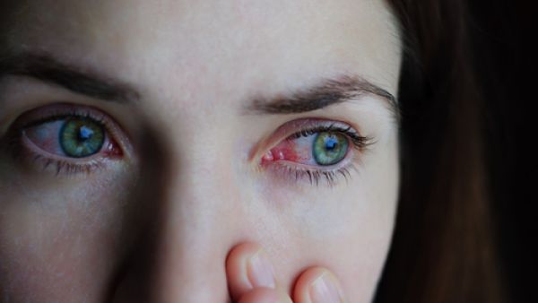 يجب تنظيف الإفرازات التي توجد في العين حتى لا تحدث اضطرابات في الرؤية (shutterstock.com)