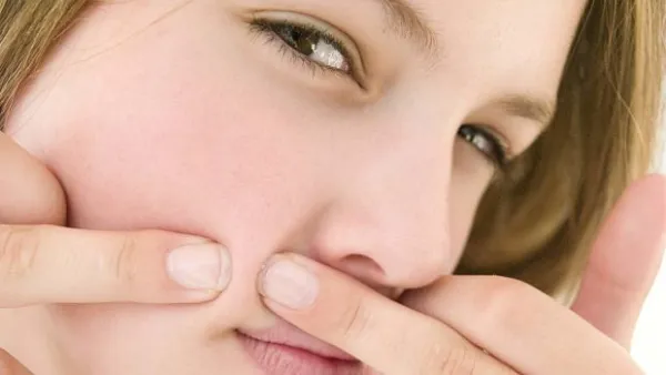 تجنب فرك الحبوب ومحاولة إزالتها بالأظافر