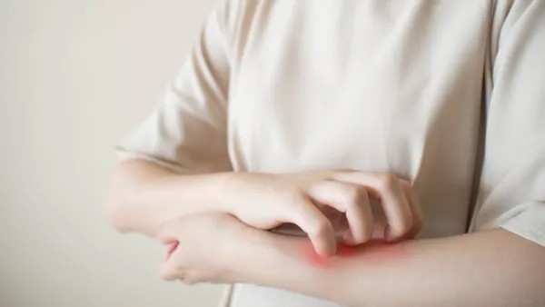 من أعراض حساسية الجلد البثور والحبوب

