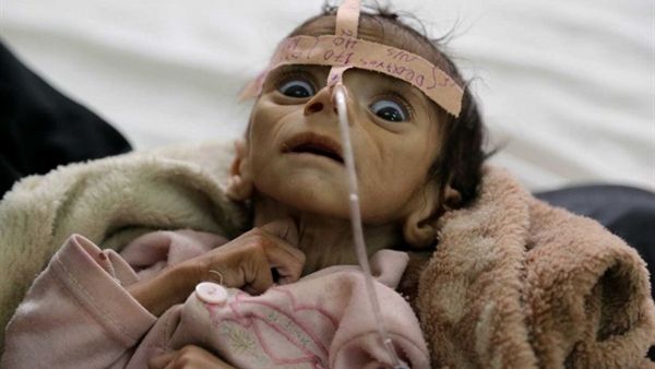 مأساة إنسانية وصلت للعالمية.. صورة مفزعة لوفاة رضيع يمني