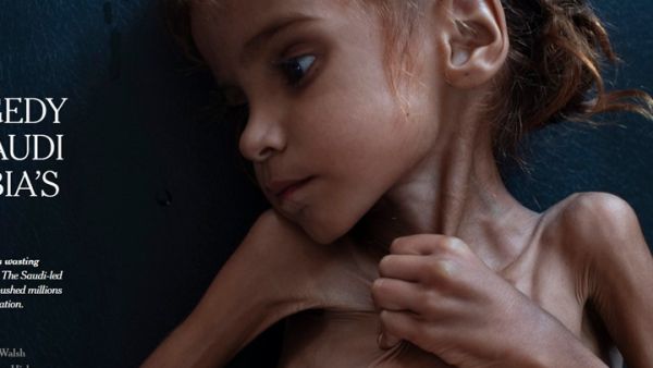 "فيسبوك" يكسر قواعده ويسمح بنشر صورة لطفلة يمنية تتضور جوعا