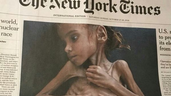 وفاة أمل اليمنية التي أثارت صورتها ضجة عالمية