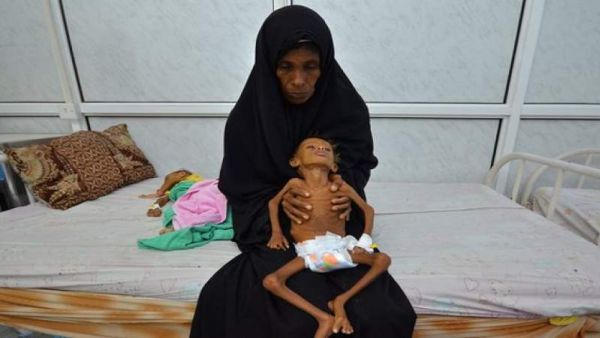  قرابة 358 ألف طفل يمني يعانون من سوء التغذية الحاد الشديد